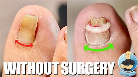 The big toe is the most common location for. . Pincer toenail treatment